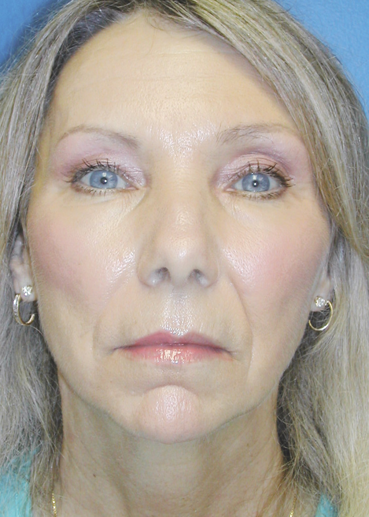 Facelift Chemical Peel29 After Vargas Face And Skin Center
