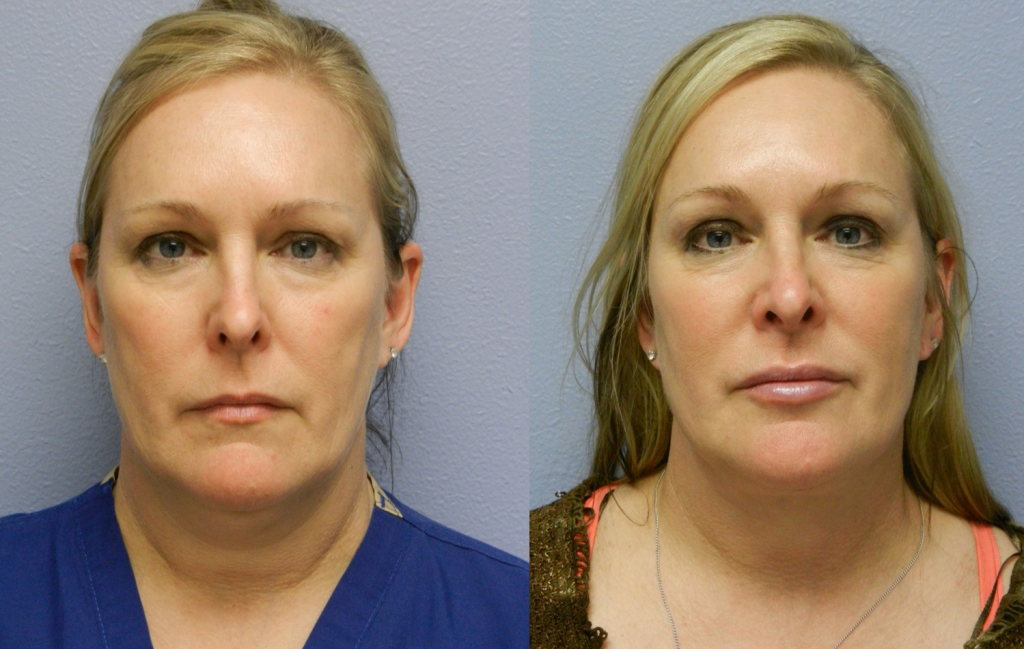 Facial Laser Liposuction Treatment - Vargas Face and Skin Center