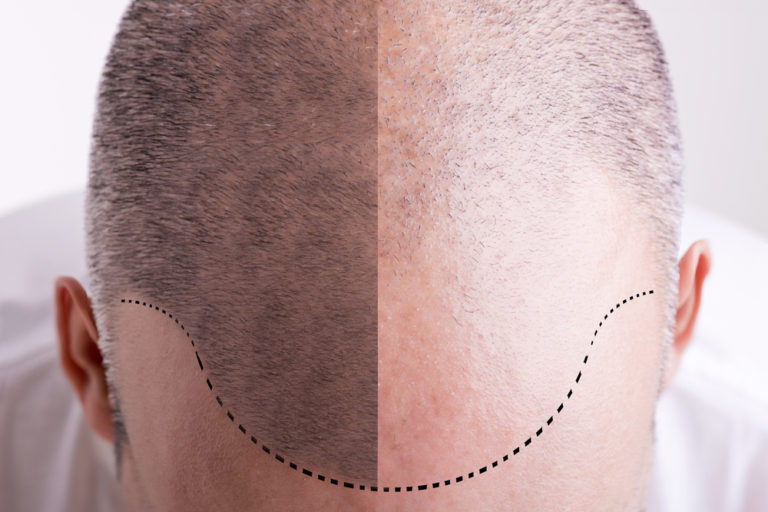 Treat Hair Loss With Prp Injections Vargas Face And Skin Center