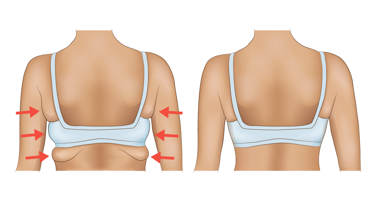 Underarm Bulge Removal (Armpit Fat) - (RTC)