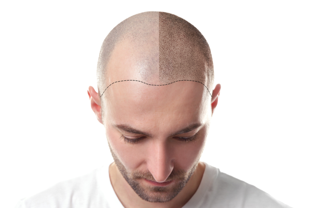 Why Men Are Balding In Their 20s Vargas Face And Skin Center