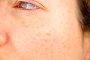 age-spots-on-skin - Vargas Face and Skin Center