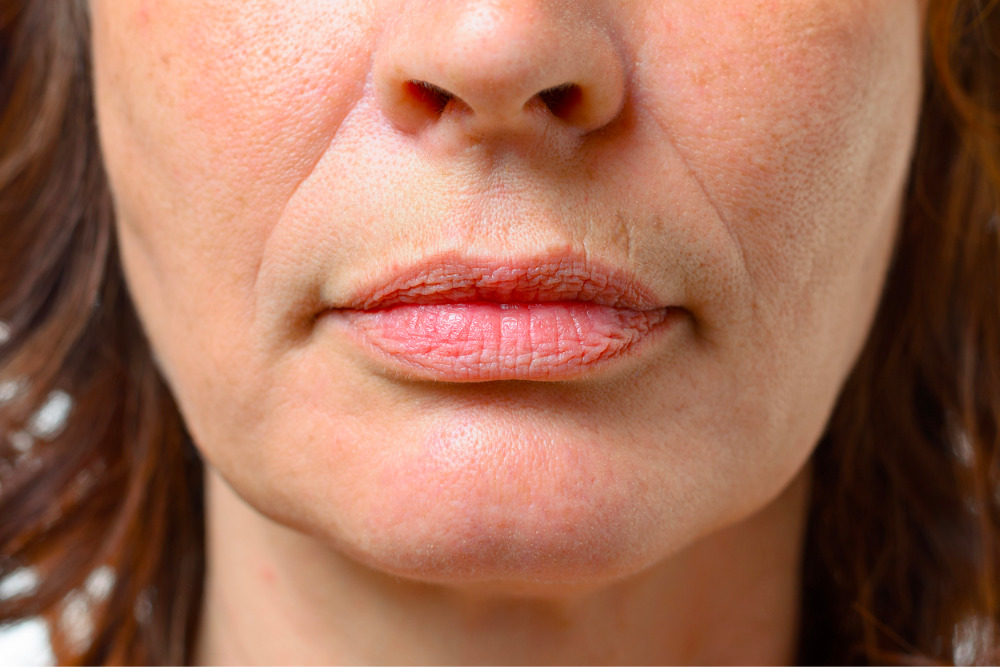 How To Get Rid Of Lip Wrinkles Vargas Face And Skin Center