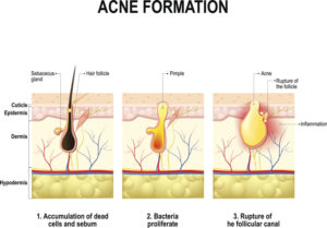 how-acne-forms - Vargas Face and Skin Center