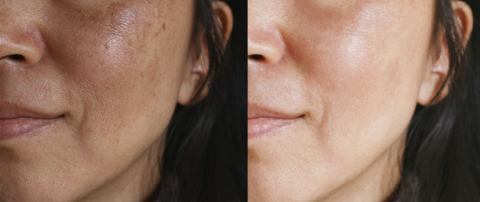 laser-peel-results